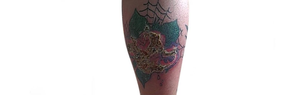 infected tattoo
