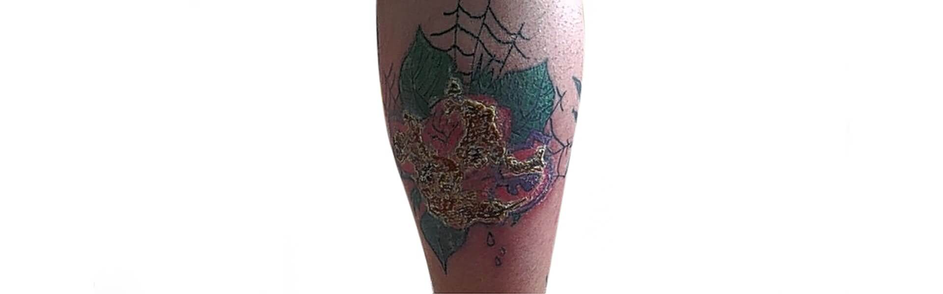 Infected Tattoo: Tips for Identification and Treatment | Skin Design Tattoo