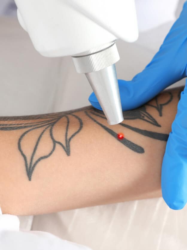 Skin Design Tattoo Leading Tattoo Removal